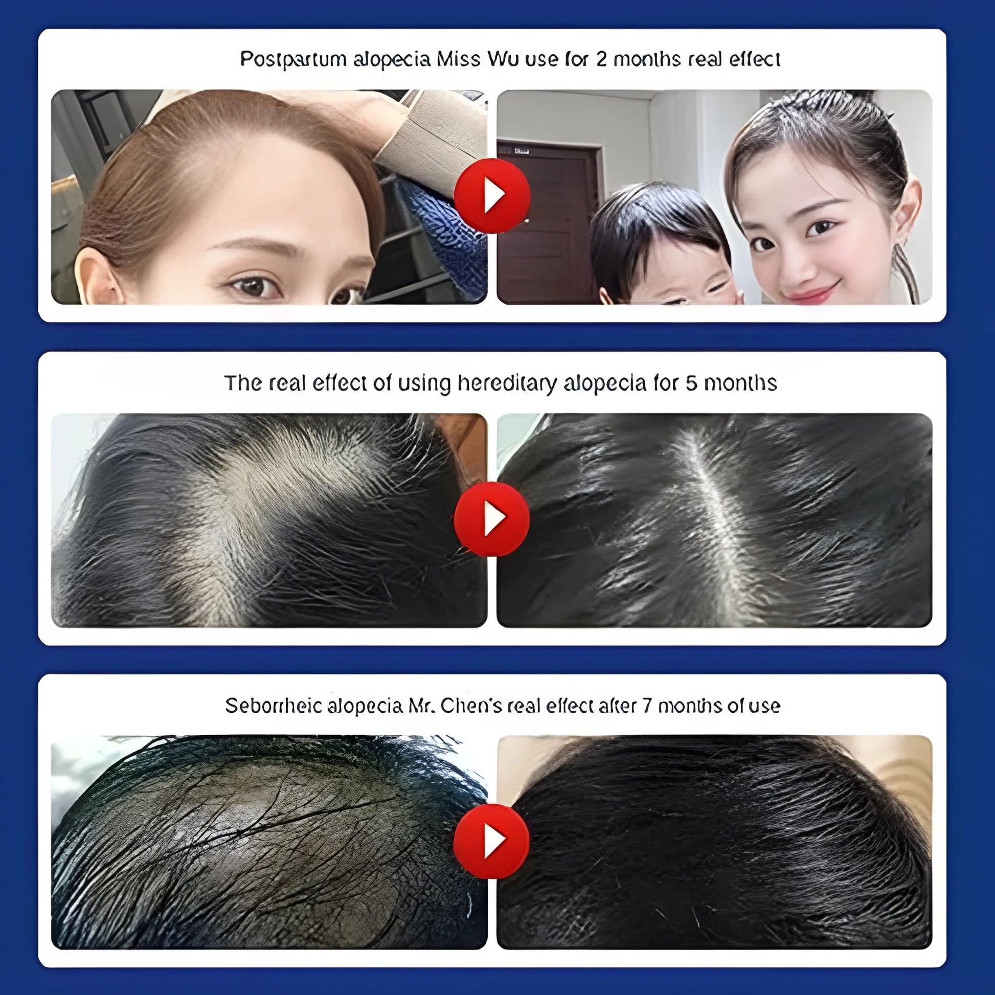 Anti Hair Loss Shampoo