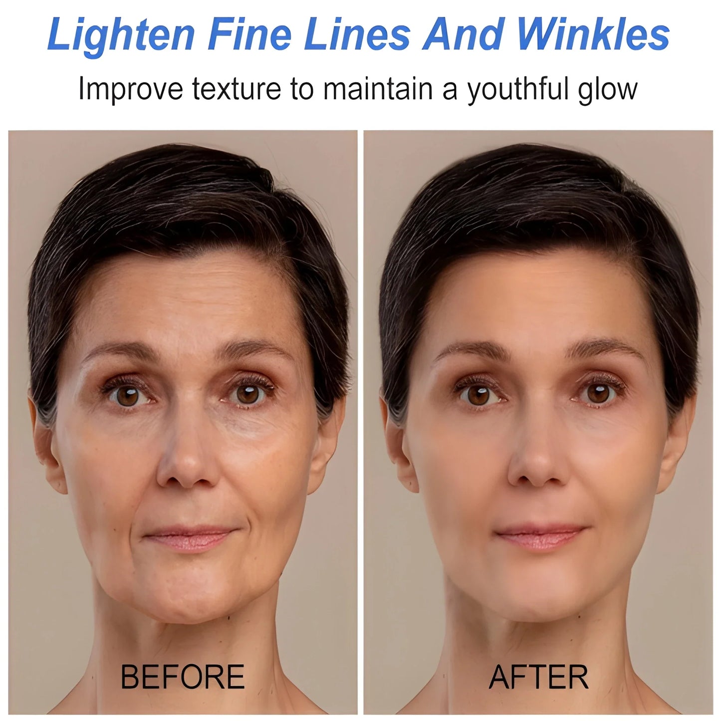 Botox Like Wrinkle Treatment