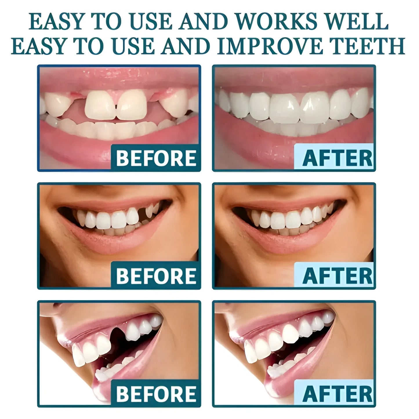 Instant Smile Veneers