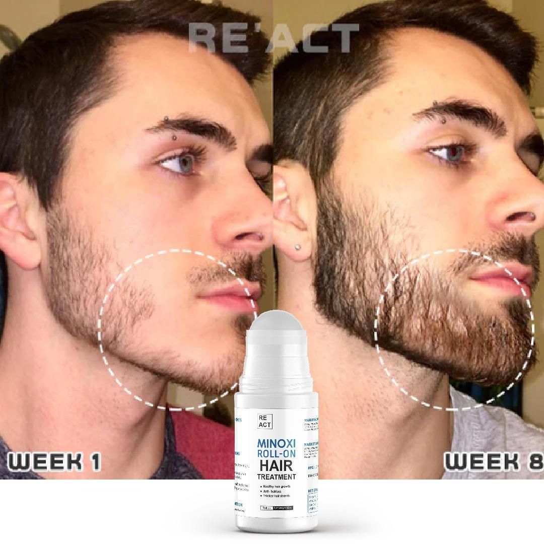 Minoxi Roll On Hair Treatment Hair Growth Serum For Women & Men