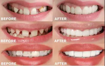 Fit Flex Cosmetic Teeth Denture