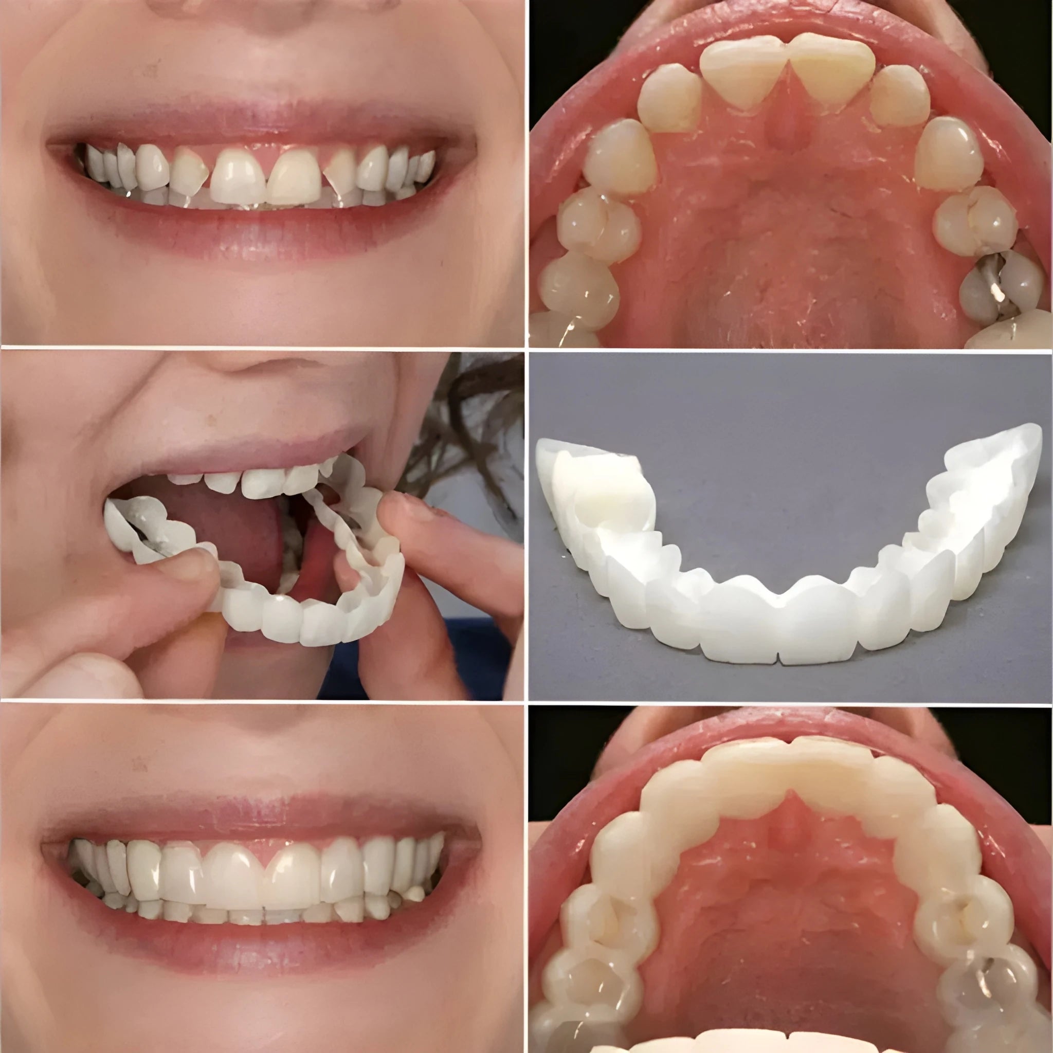 Flexi Fit Smile Veneers