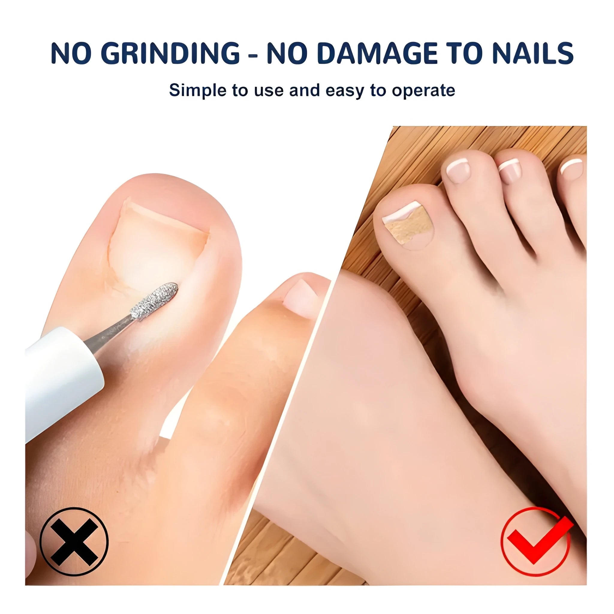 Ingrown Toenail Corrector Stickers