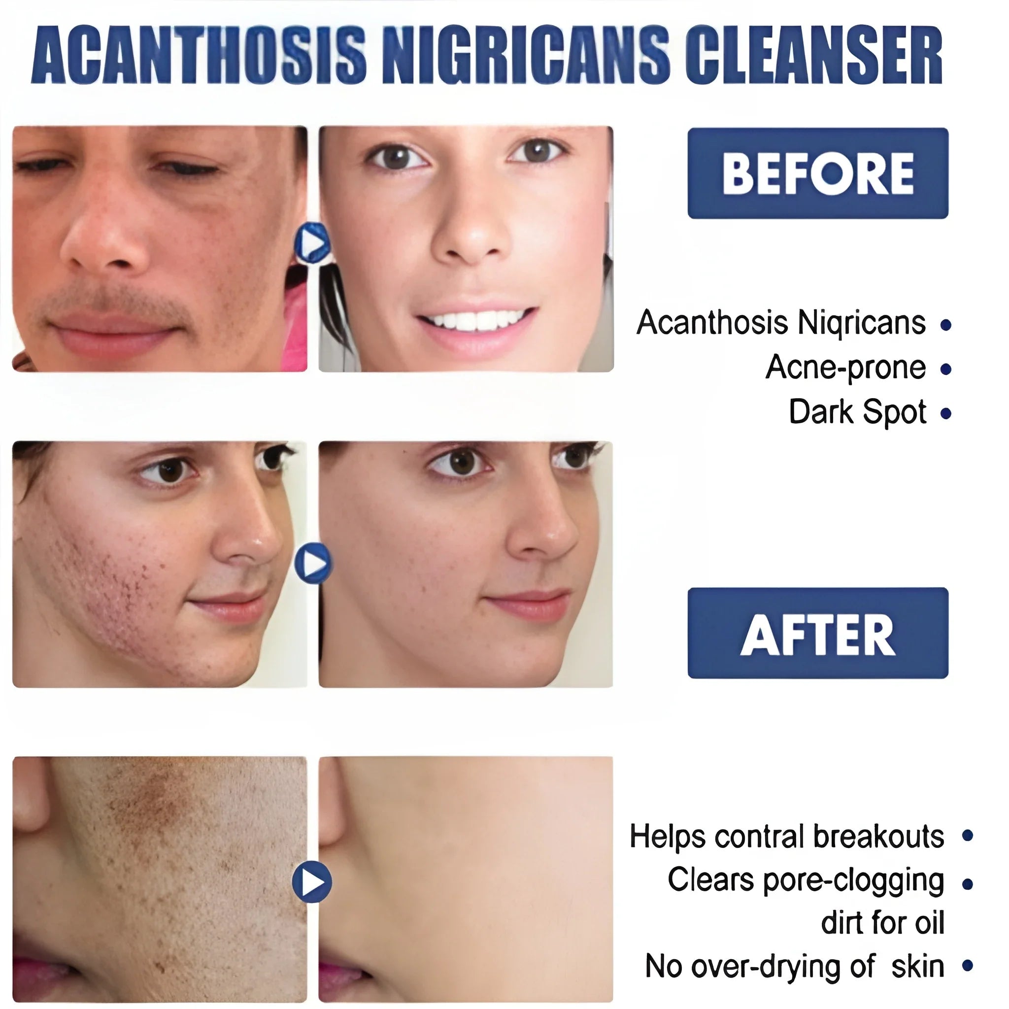 Acne Spot Treatment Lotion