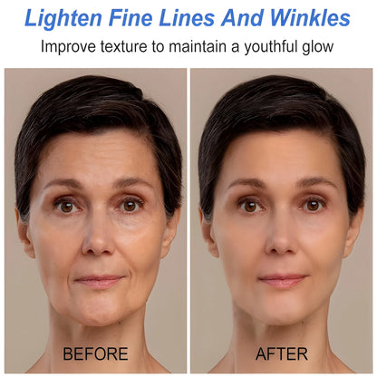 Botox Like Wrinkle Treatment