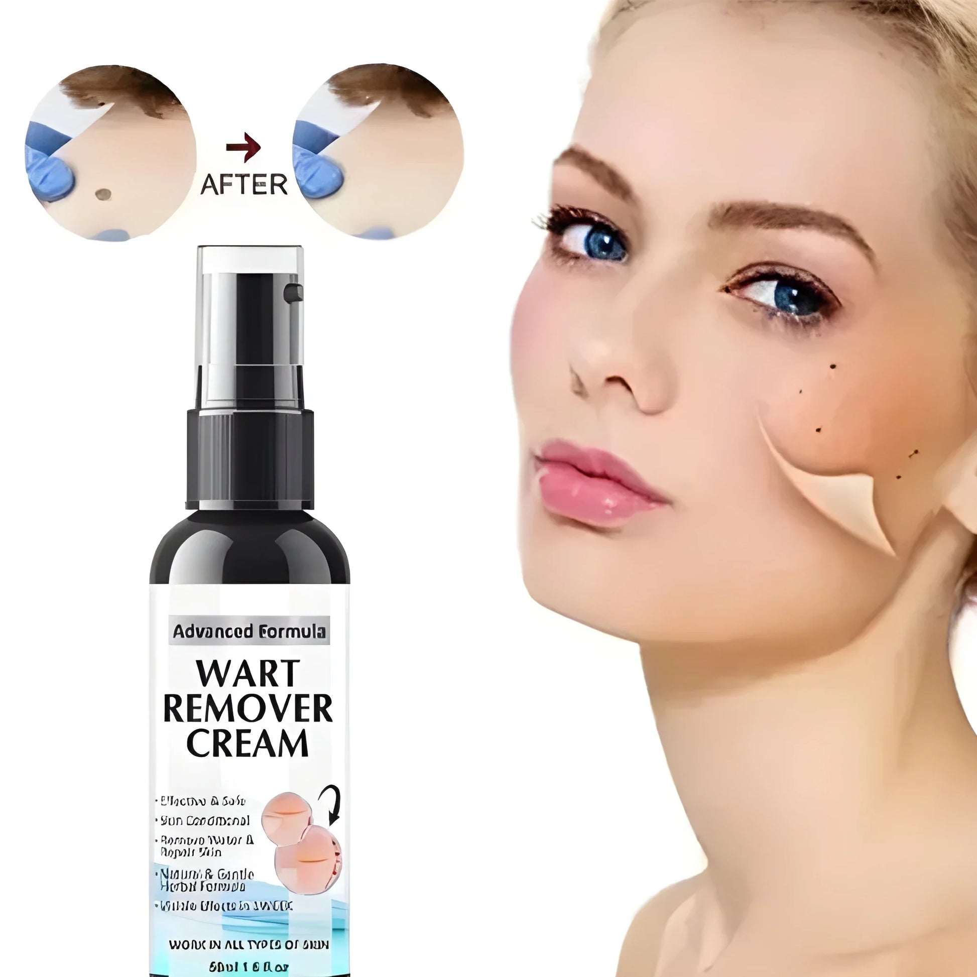 Fezora Wart Remover Cream – Pack of 2