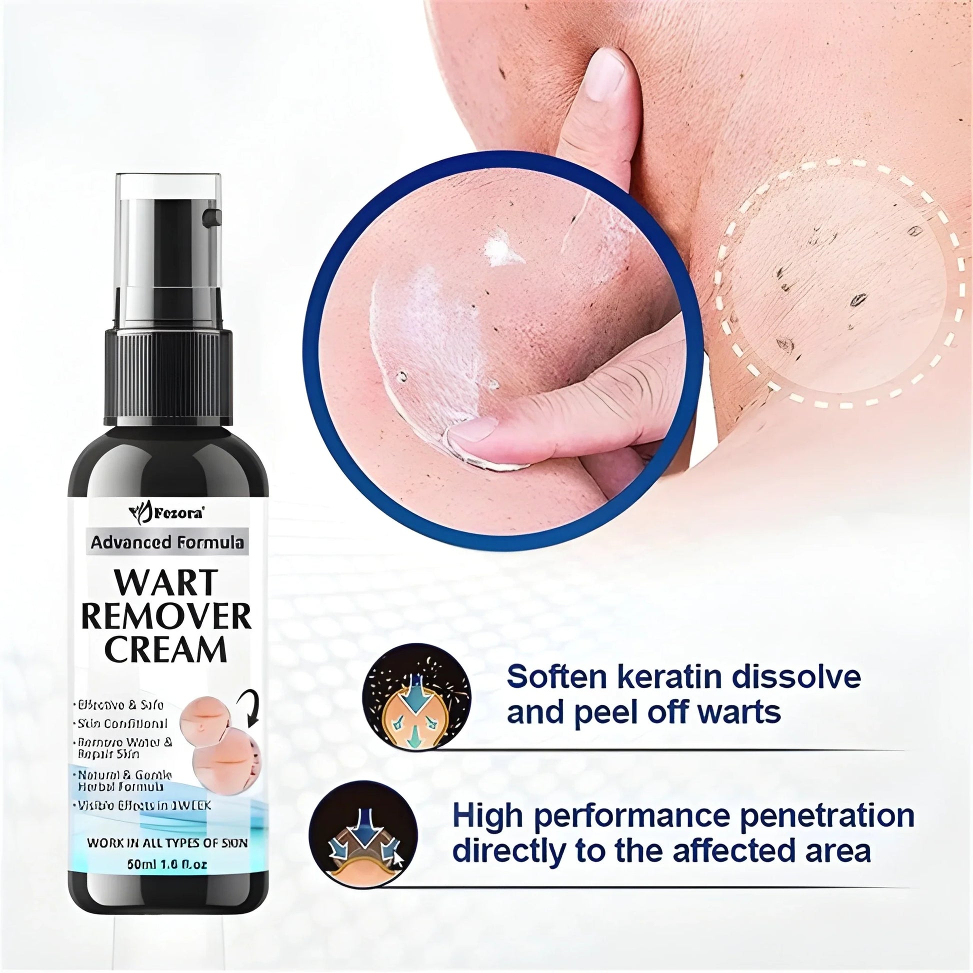 Fezora Wart Remover Cream – Pack of 2