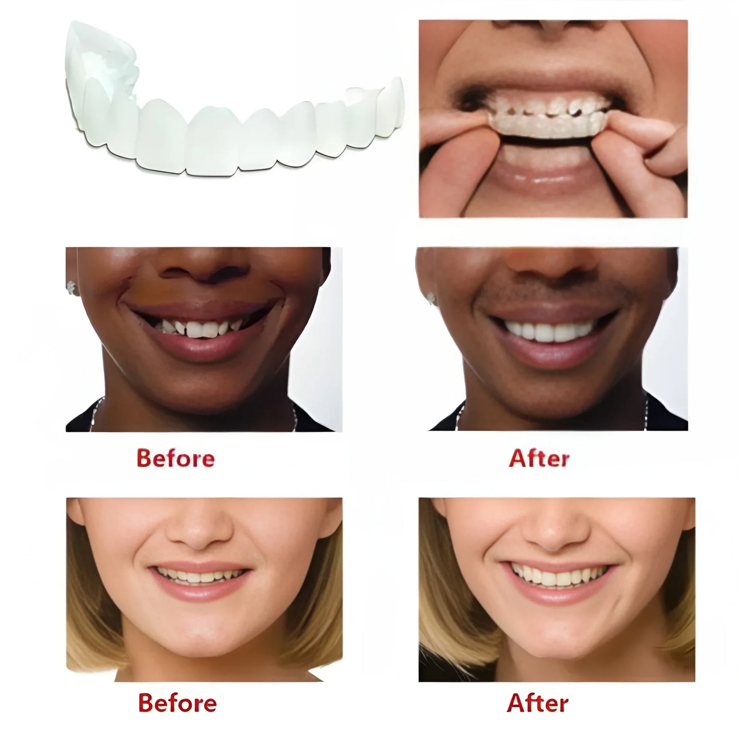 Flexi Fit Smile Veneers