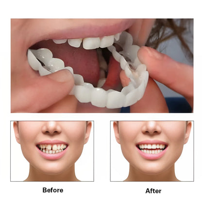 Flexi Fit Smile Veneers