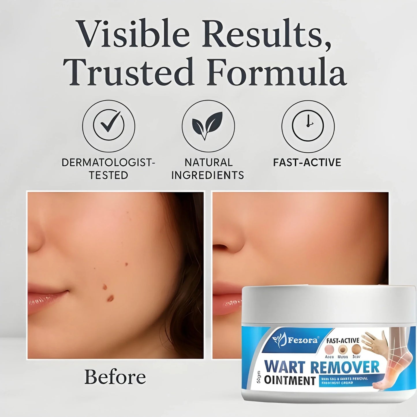 Gentle Wart Removal Cream