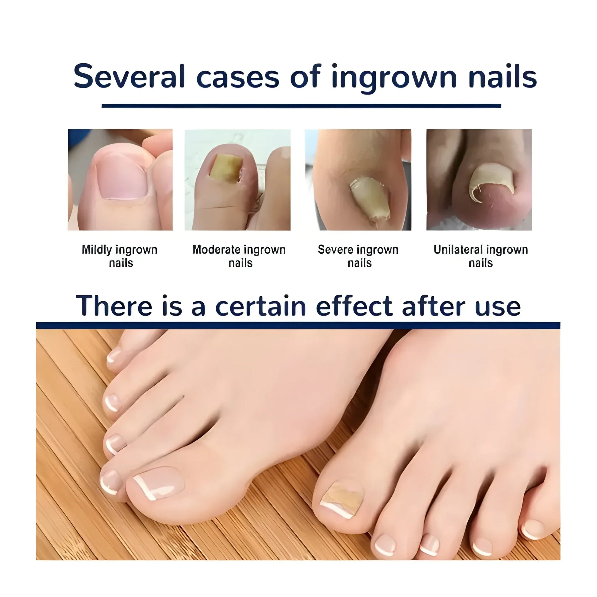 Ingrown Toenail Corrector Stickers