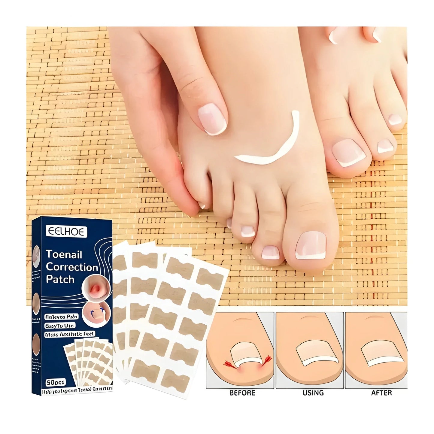 Ingrown Toenail Corrector Stickers