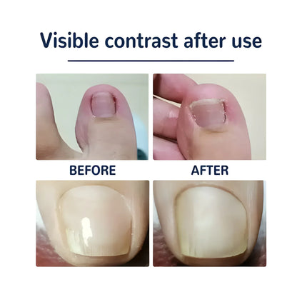 Ingrown Toenail Corrector Stickers