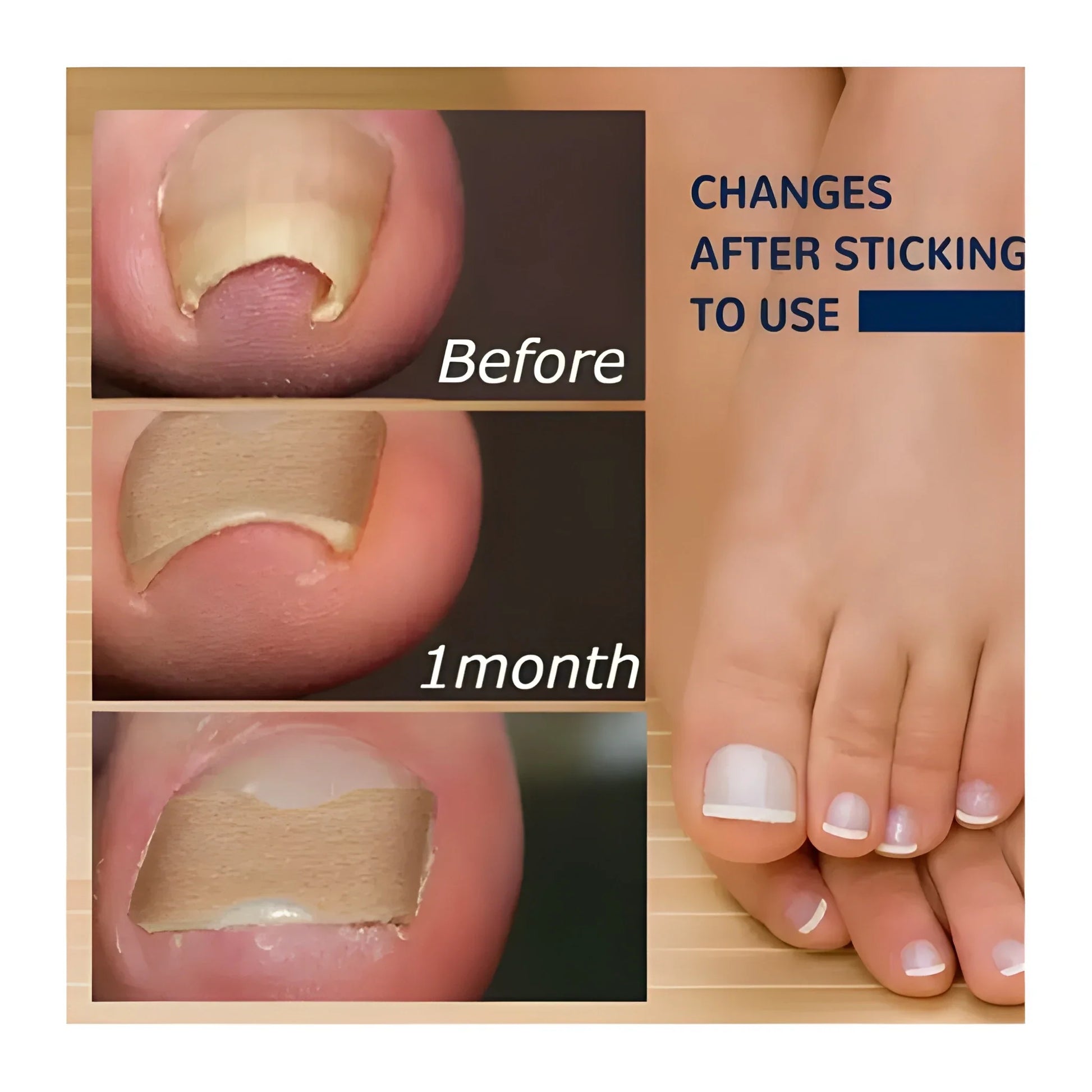 Ingrown Toenail Corrector Stickers
