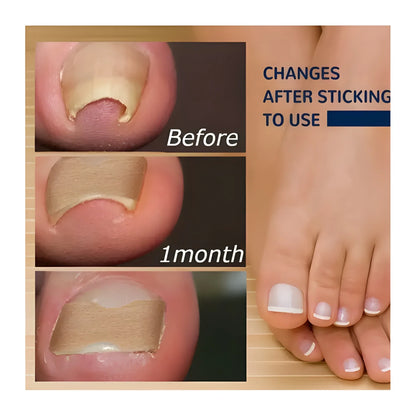 Ingrown Toenail Corrector Stickers