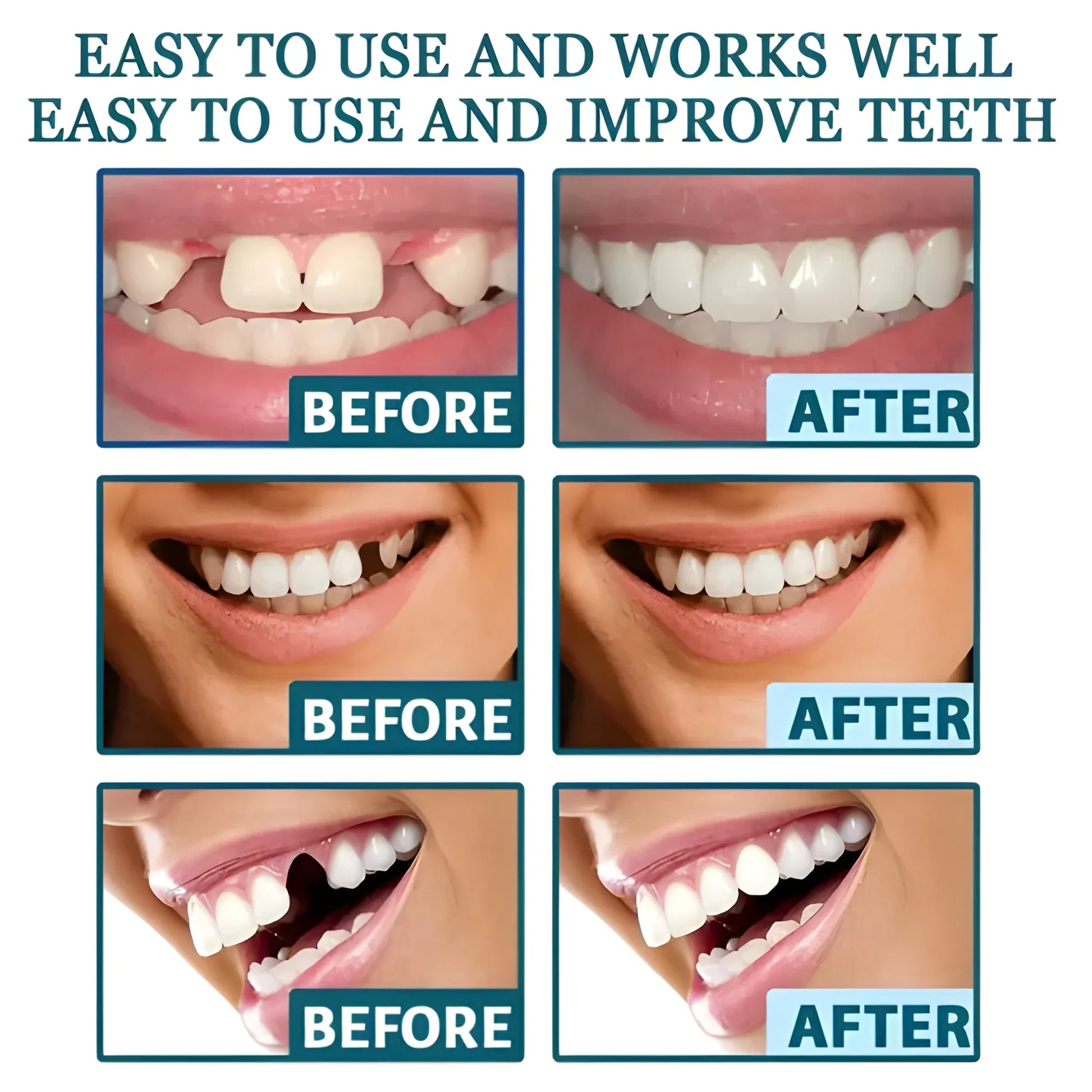 Instant Smile Veneers