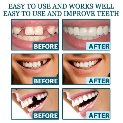 Instant Smile Veneers