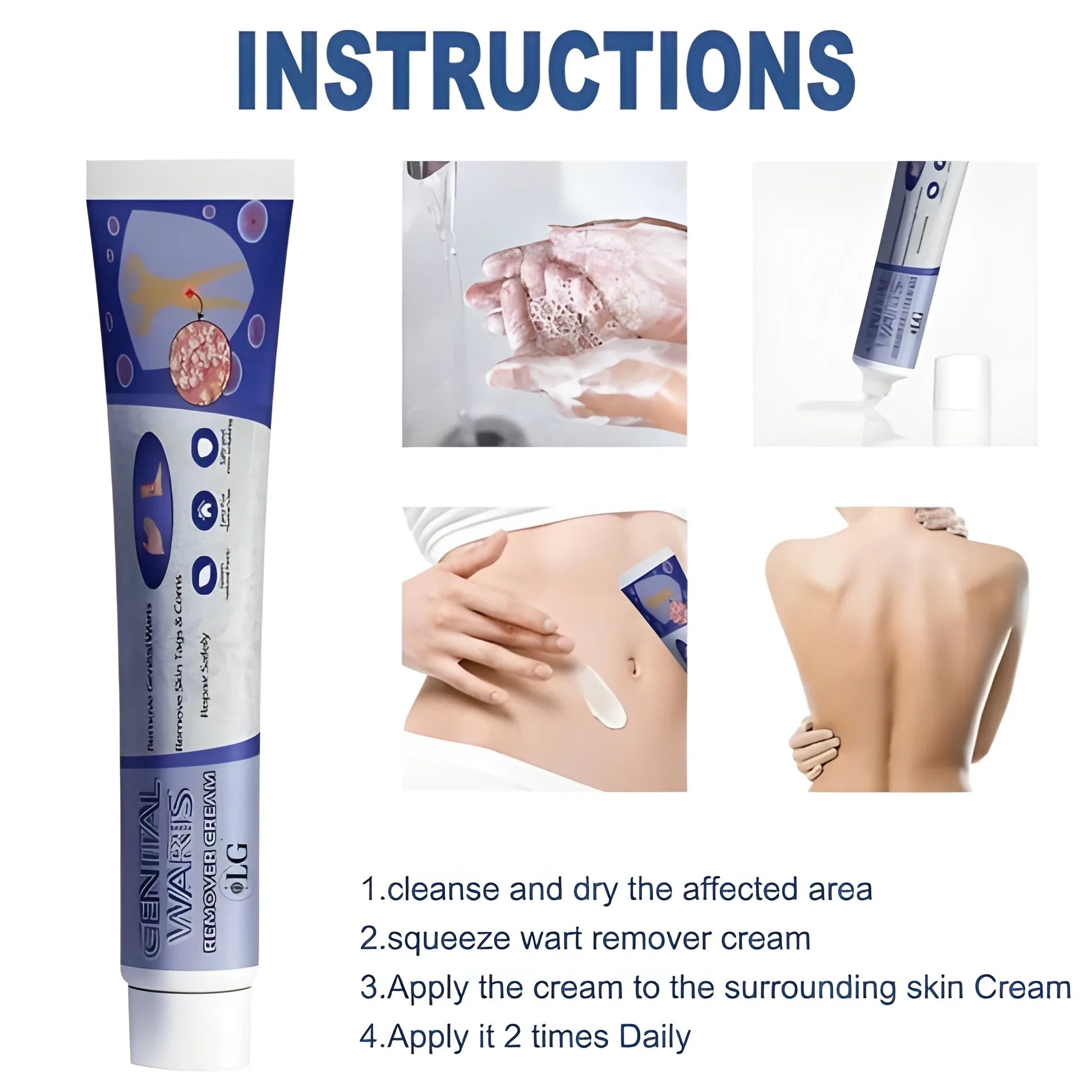 Intimate Wart Remover Cream