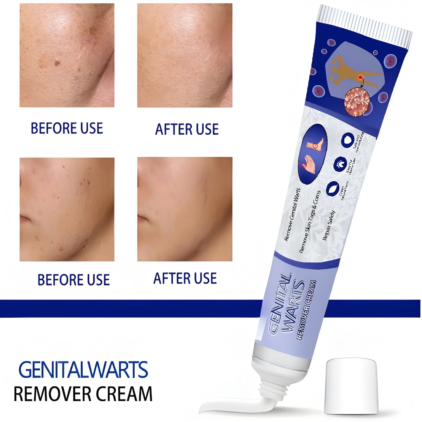 Intimate Wart Remover Cream