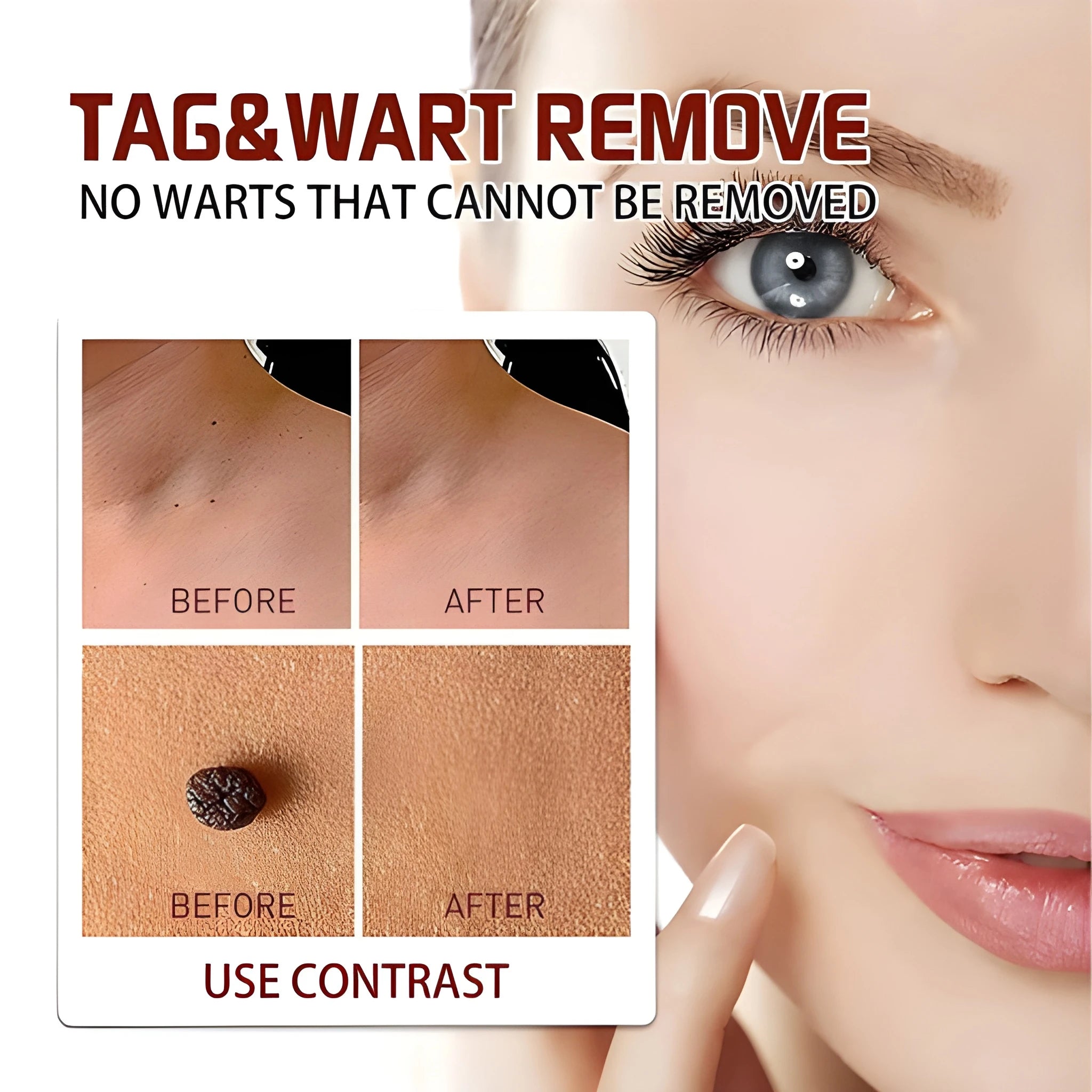 Skin Tag Remover Cream