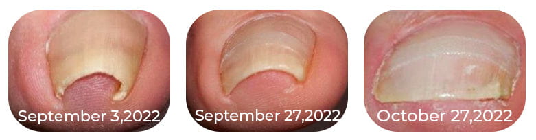 Toenail and Nail Care Oil – Softens and Cleans Nails