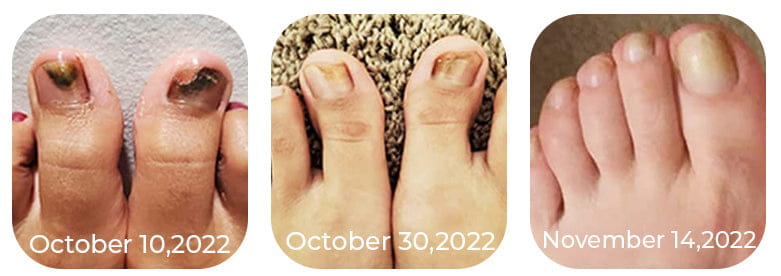 Toenail and Nail Care Oil – Softens and Cleans Nails