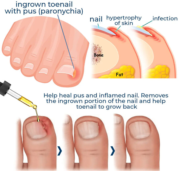 Toenail and Nail Care Oil – Softens and Cleans Nails