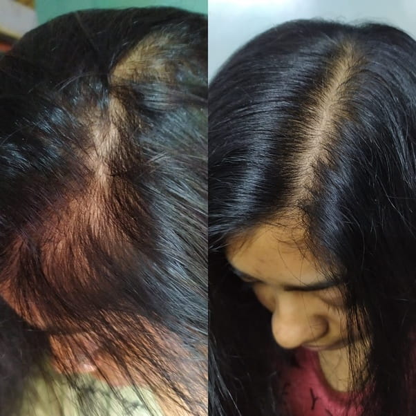 Has anyone successfully regrown hair using any natural method (with before  and after photos)? - Quora