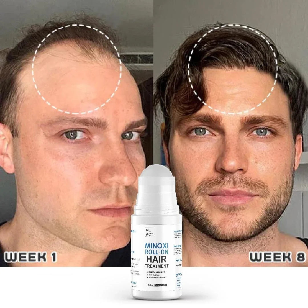 Minoxi Roll On Hair Treatment Hair Growth Serum For Women & Men
