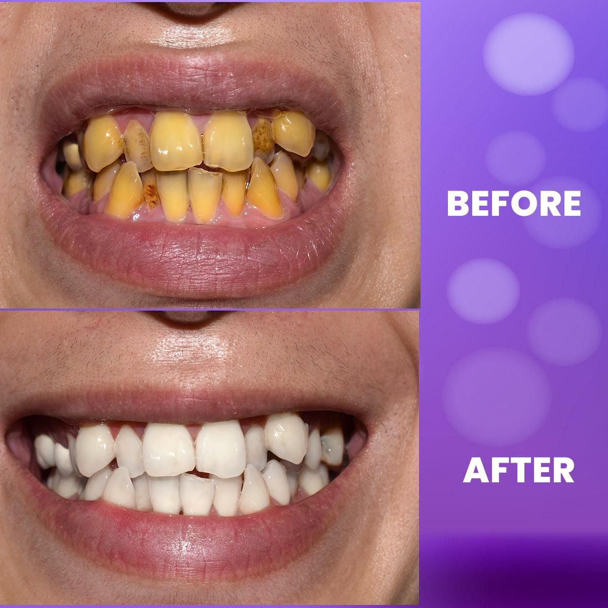 Purple Teeth Whitening Gel Toothpaste