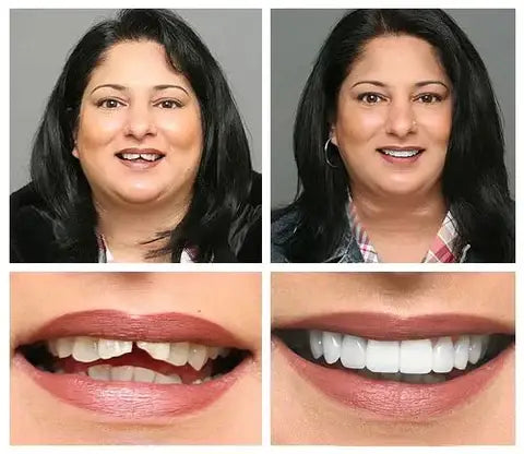 Fit Flex Cosmetic Teeth Denture