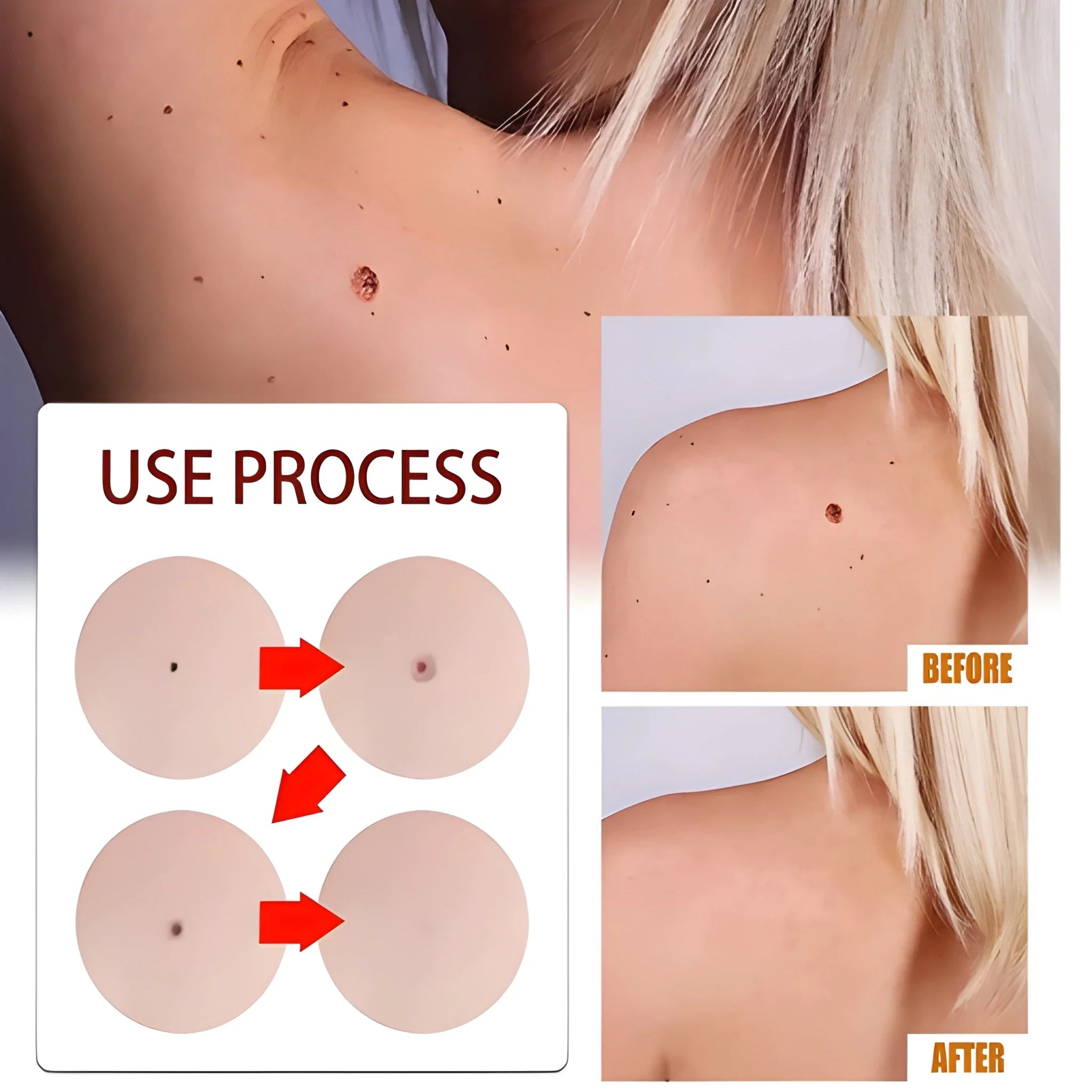 Skin Tag Remover Cream